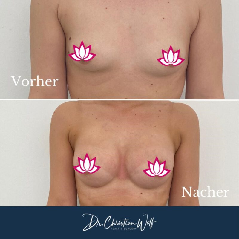 Brustvergrößerung