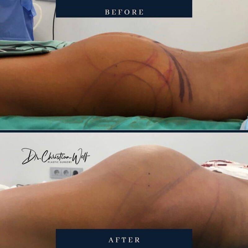 Brazilian Butt Lift